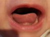 frein-langue.png