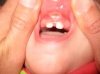 Frein de levre coupe correctement.jpg