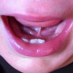 Frein lingual