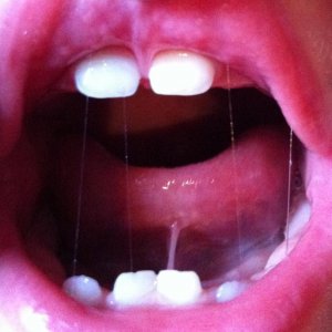 Freins labial et lingual
