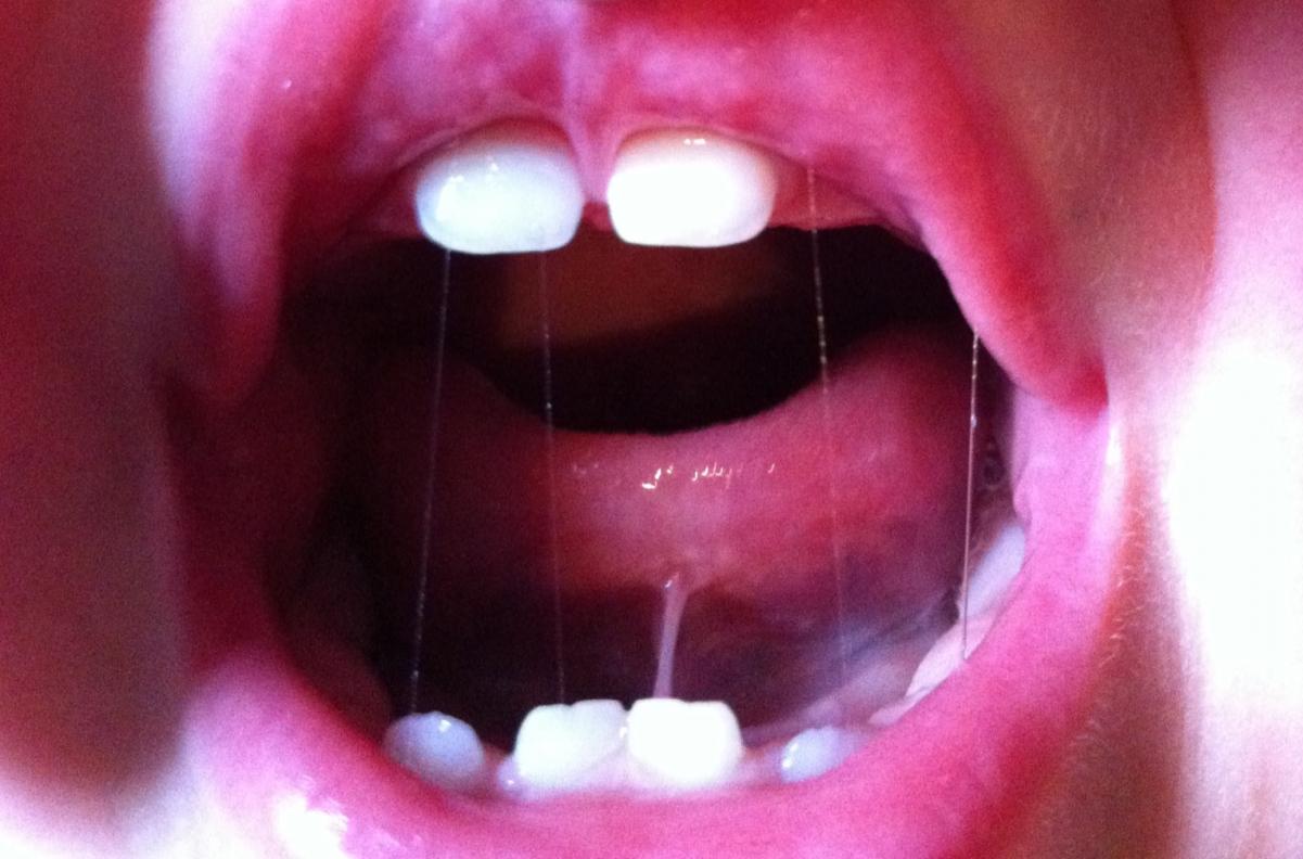 Freins labial et lingual